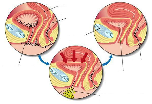 Bakterien in der Blase bei Blasenentzündung